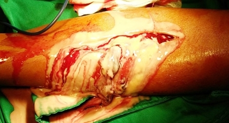 Thầy lang chữa bệnh khiến bé trai 9 tuổi suýt mất chân